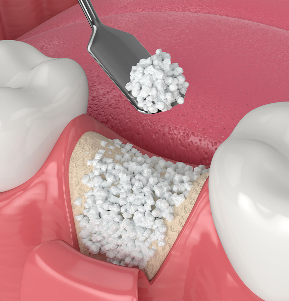 bone grafting graphic