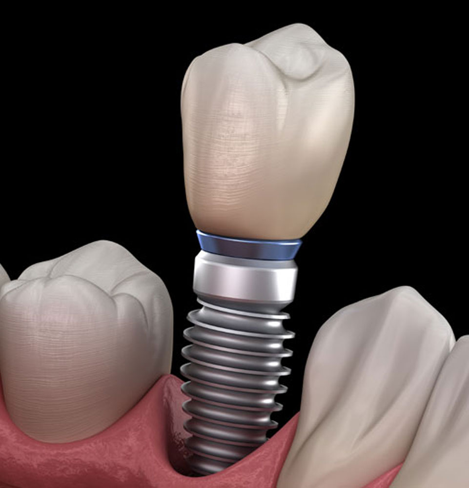 single tooth implant